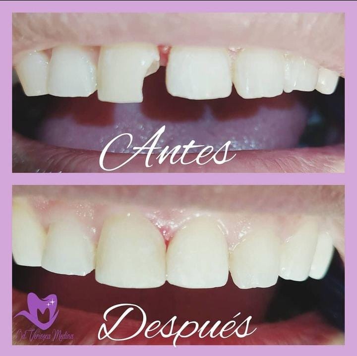 Implantes dentales
